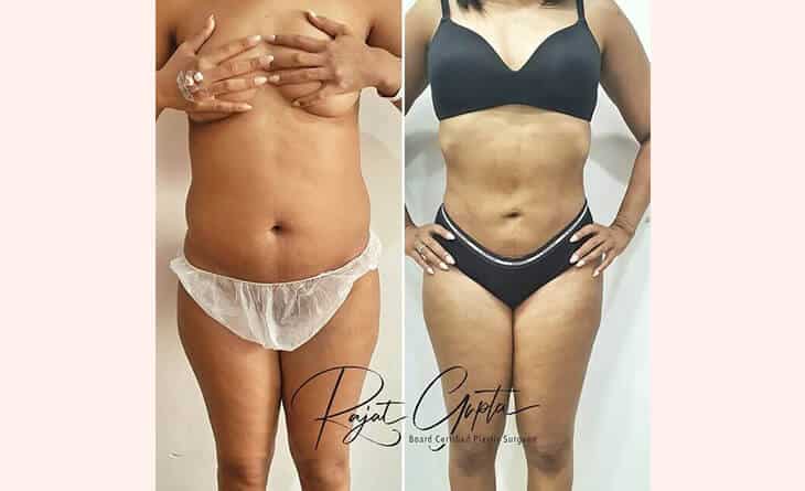 Liposuction surgery