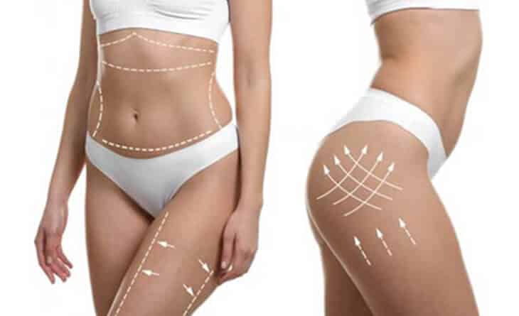 Liposuction surgery