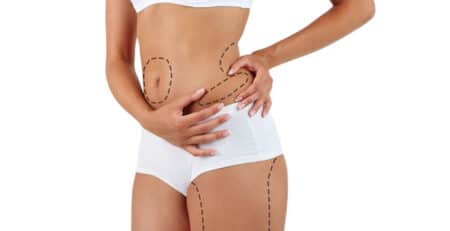 Liposuction surgery