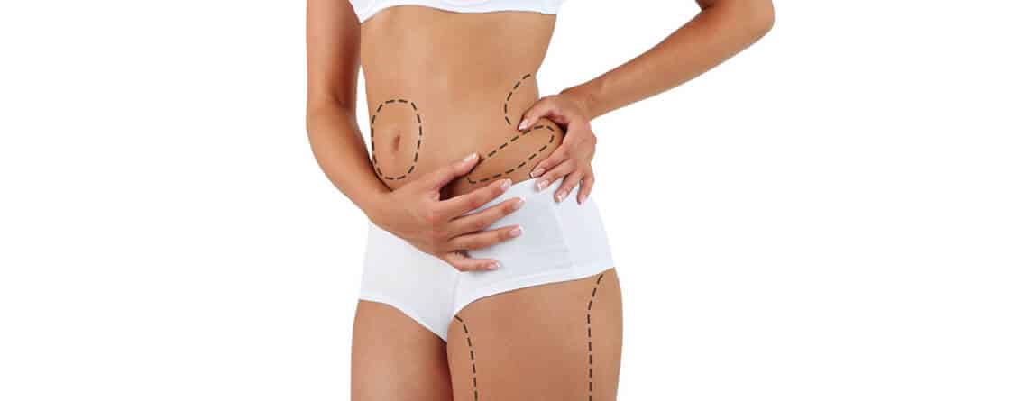 Liposuction surgery