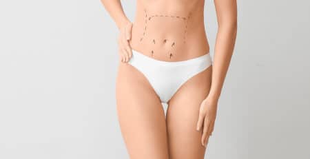 Liposuction procedure