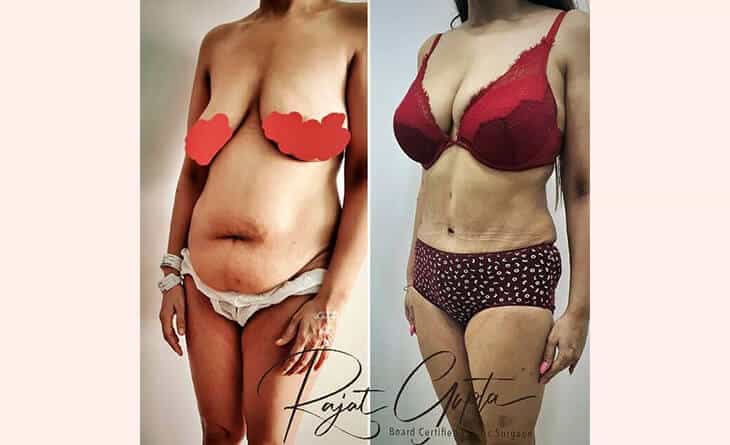 Liposuction procedure