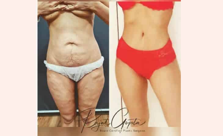 Tummy Tuck Before After Result