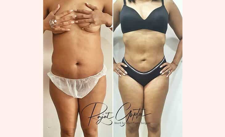 liposuction surgery