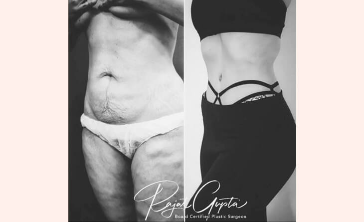 tummy tuck surgery