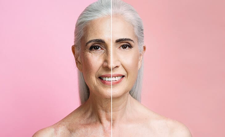 facelift surgery