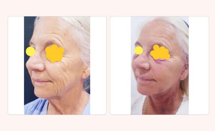 facelift surgery