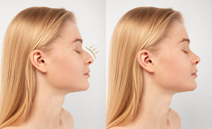 rhinoplasty surgery