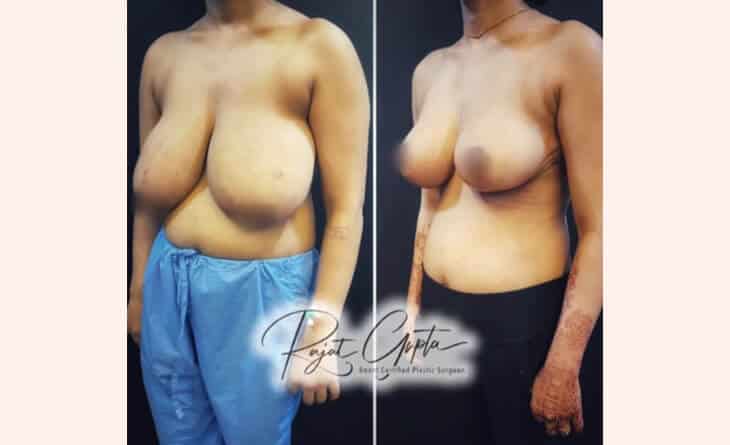 Breast Augmentation Surgery