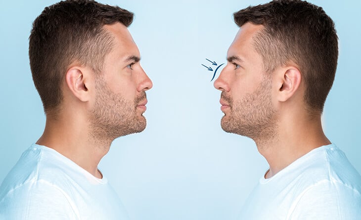 revision rhinoplasty