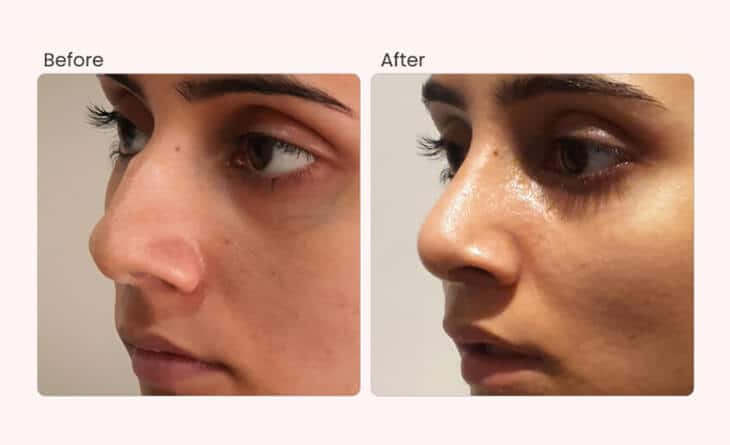 rhinoplasty cost