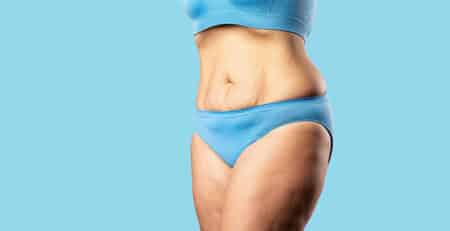 Tummy tuck surgery