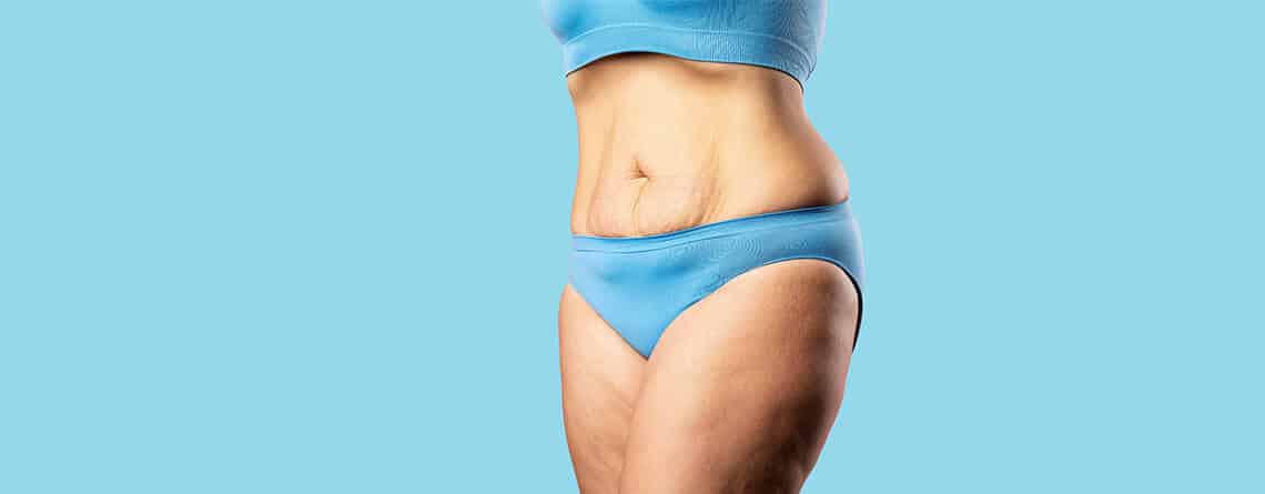 Tummy tuck surgery