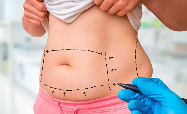 Tummy tuck surgery