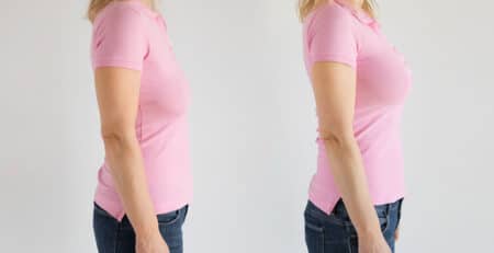 Tummy Tuck Surgery