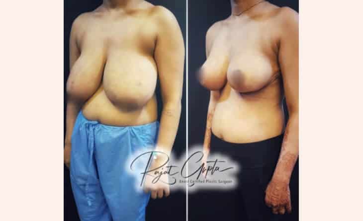 breast reduction surgery