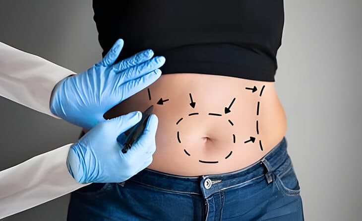Liposuction surgery