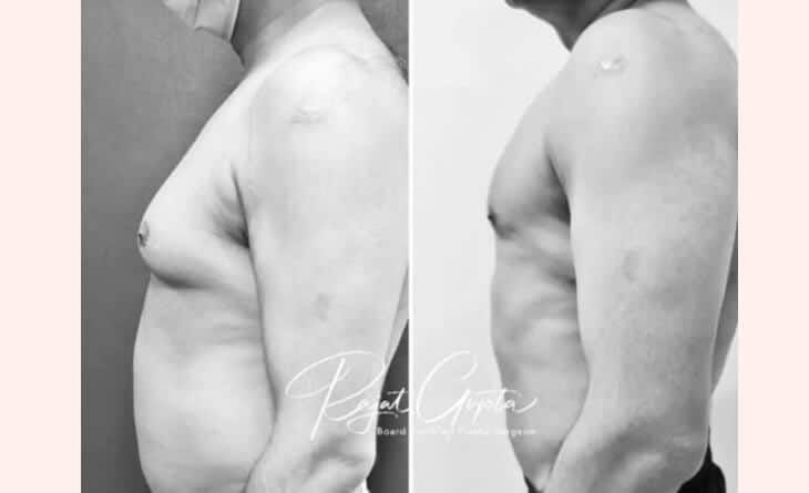 Gynecomastia surgery
