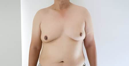 Gynecomastia surgery
