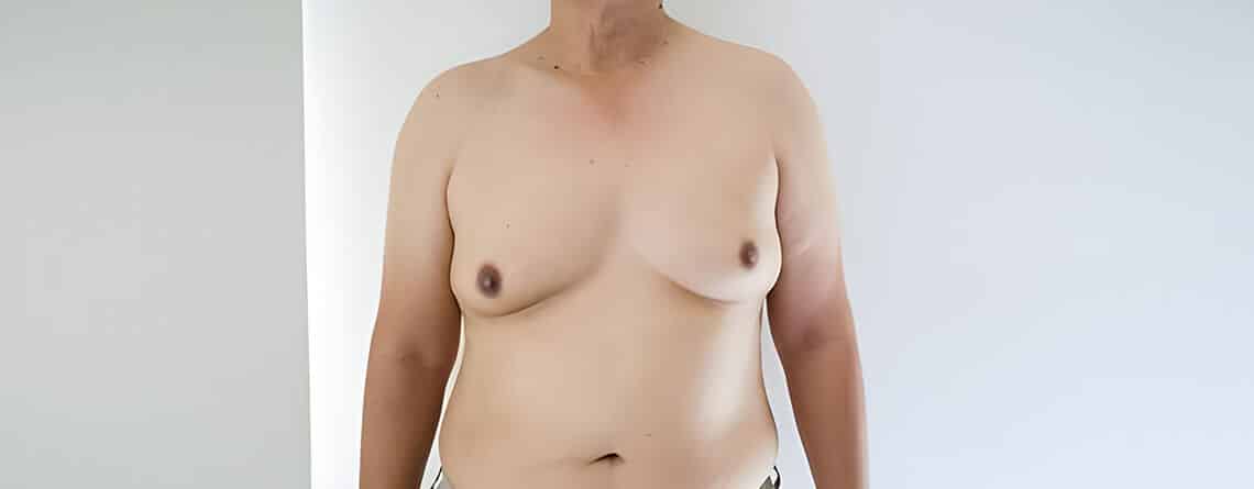 Gynecomastia surgery