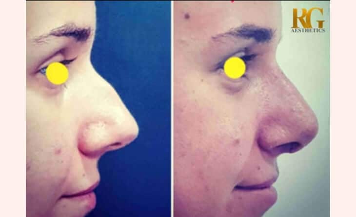 Ultrasonic nose job