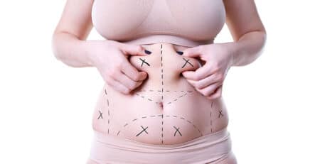 liposuction surgery