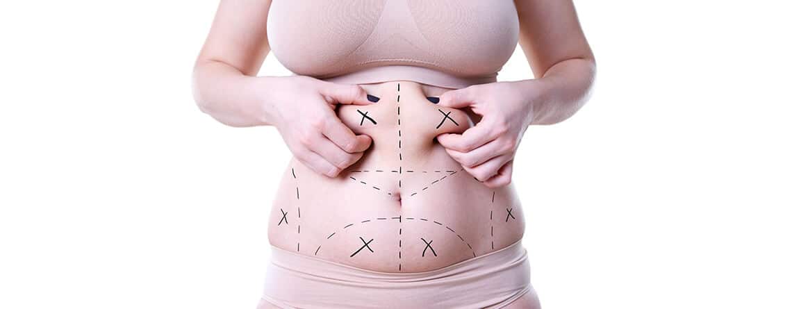 liposuction surgery
