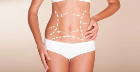 liposuction surgery