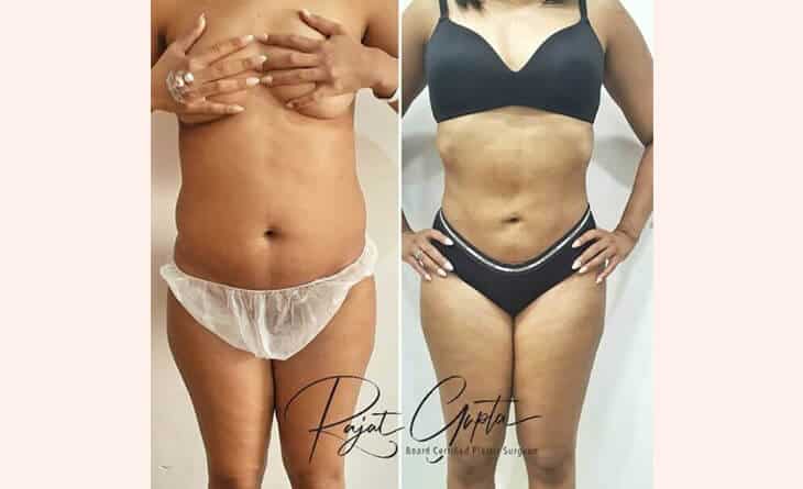 liposuction surgery