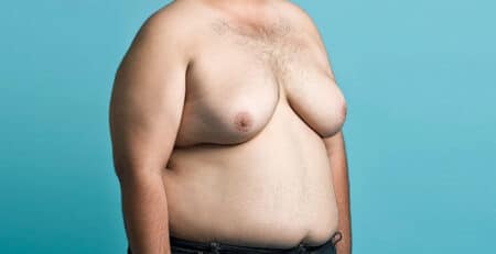 Gynecomastia Surgery