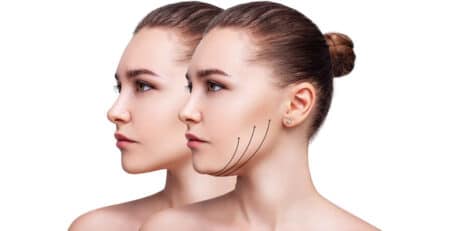 mini facelift surgery