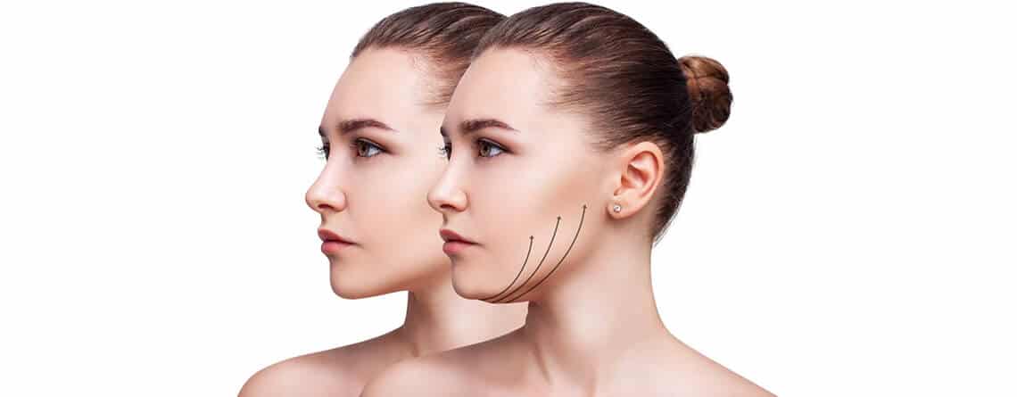 mini facelift surgery