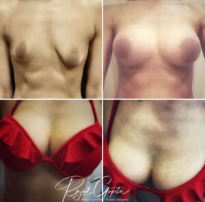 Breast Augmentation