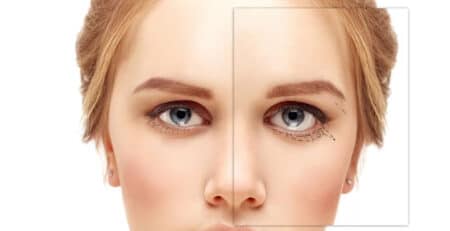 Blepharoplasty Surgery