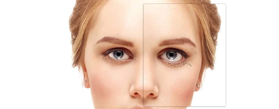 Blepharoplasty Surgery