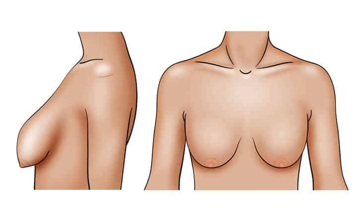 Perky Breast
