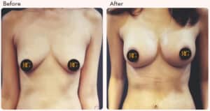 Breast Augmentation