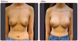 Breast Augmentation