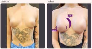 Breast Augmentation