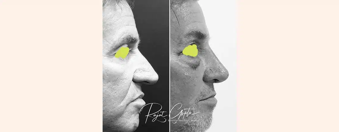 Types of nose jobs