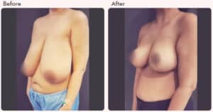 breast reduction surgery