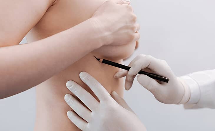 Breast Reconstruction Surgery