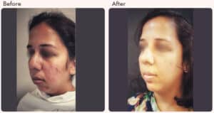 chin augmentation