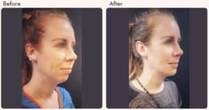 chin augmentation