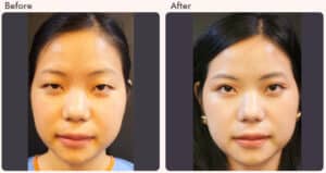blepharoplasty