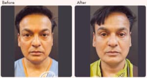 blepharoplasty