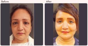 blepharoplasty