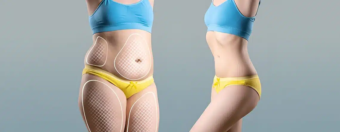 Tummy Tuck Surgery