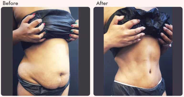 tummy tuck surgery