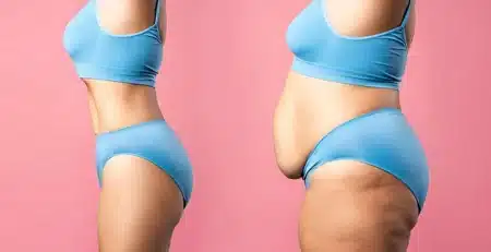 tummy tuck surgery